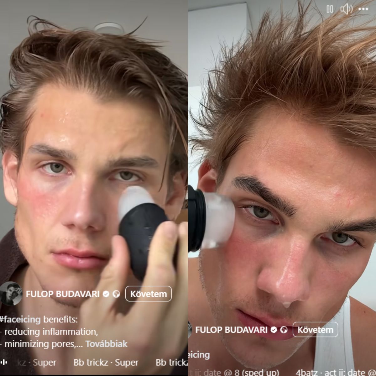 Budavári Fülöp szekszárdi származású influencer a szép arcbőrrel kapcsolatban is útmutatást adott rajongóinak. A jégkockára esküszik.